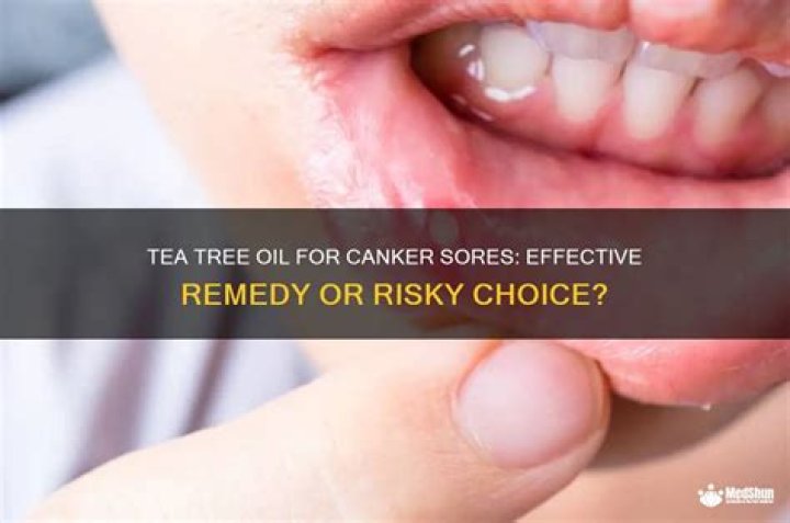 Can you put tea tree oil on canker sores?