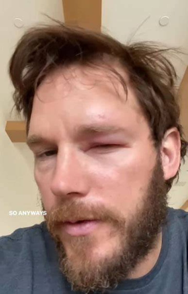 Chris Pratt got stung in the eye after copying a TikTok beekeeper