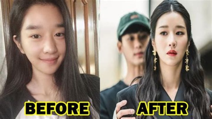 Seo Ye Ji Plastic Surgery