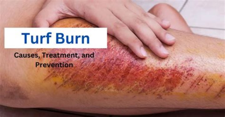 What causes turf burn?